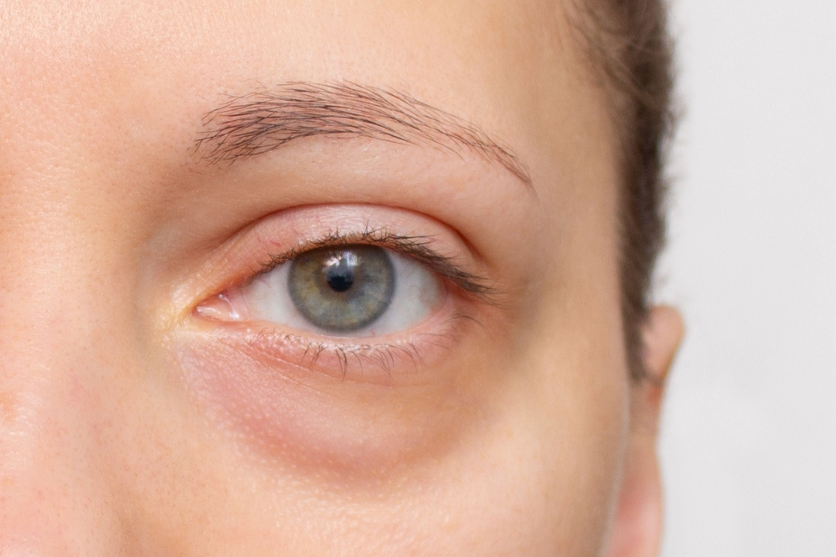 Why Do My Eyes Look Puffier in Spring?