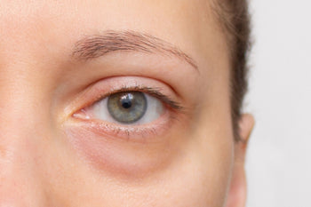 Tired woman with puffy eyes